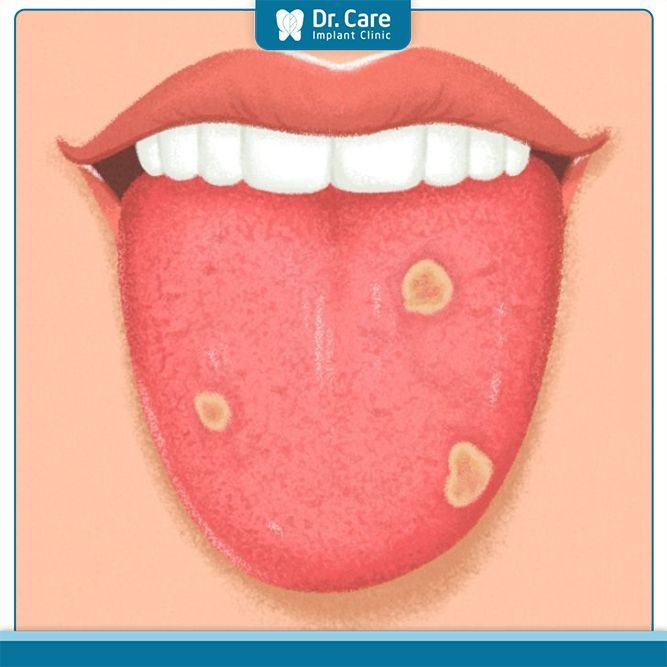 Lưỡi đốm đỏ chảy máu, đau rát có nguy hiểm không?