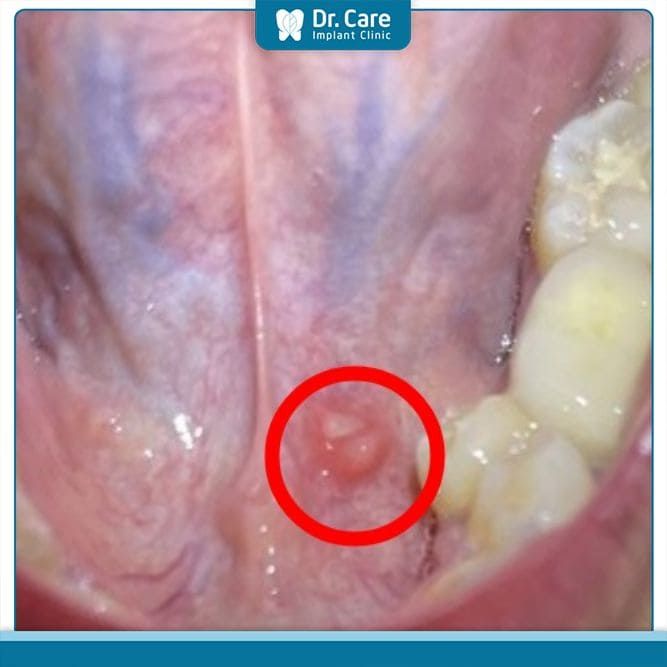 Một số câu hỏi về tình trạng lưỡi nổi mụn thịt 