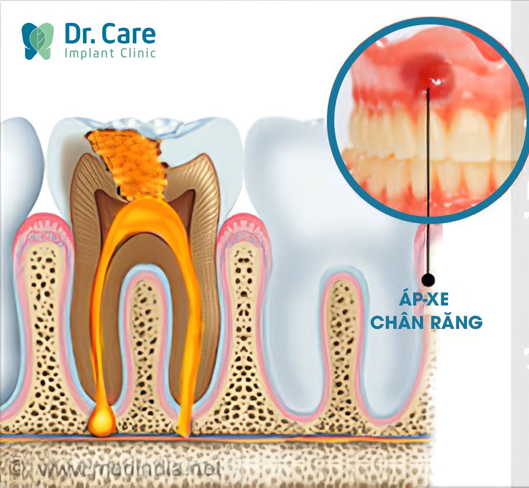 Áp-xe quanh chóp gây đau răng 