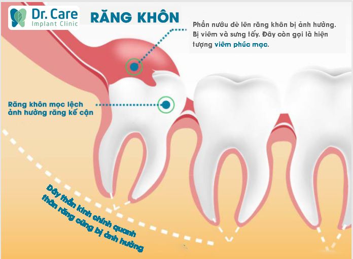 Mọc răng khôn (viêm quanh thân răng)