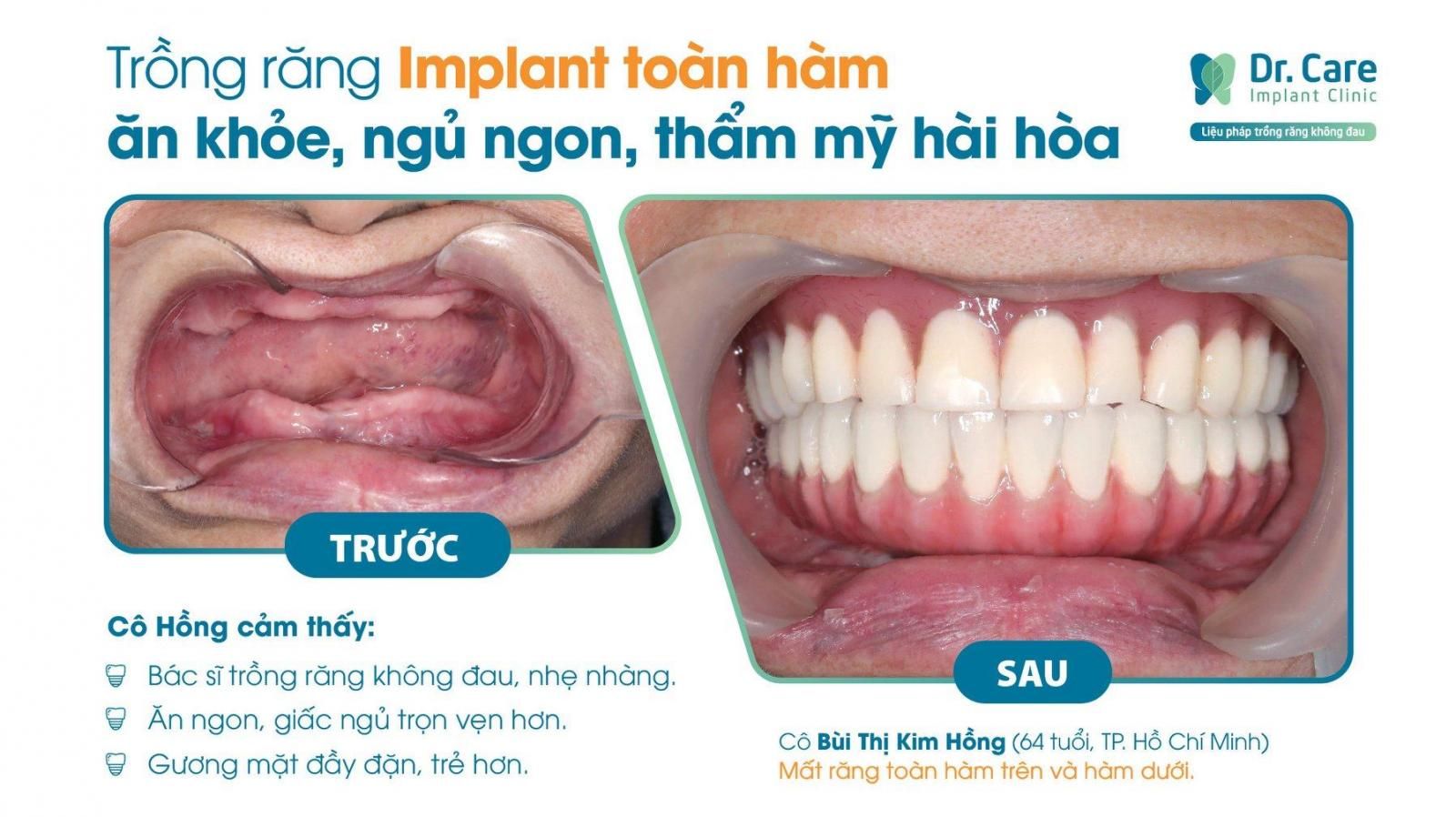 hàm tháo lắp và implant