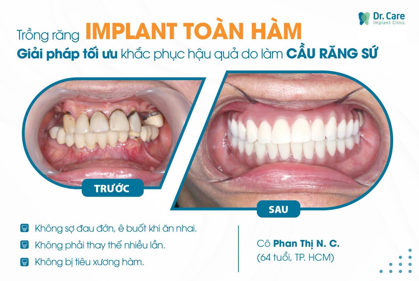 Impalnt toàn hàm và cầu răng sứ