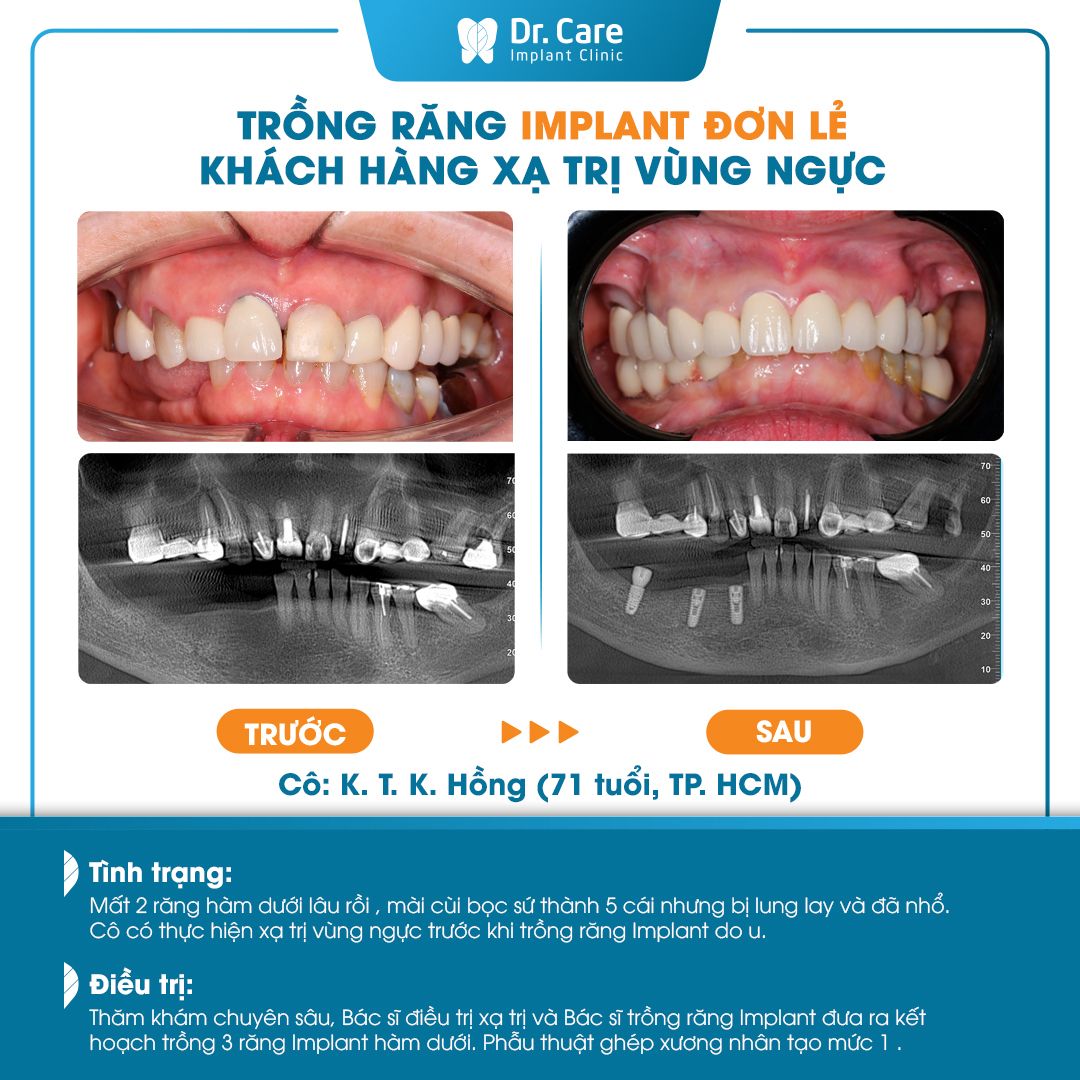 Xét đến phương pháp cấy ghép phù hợp