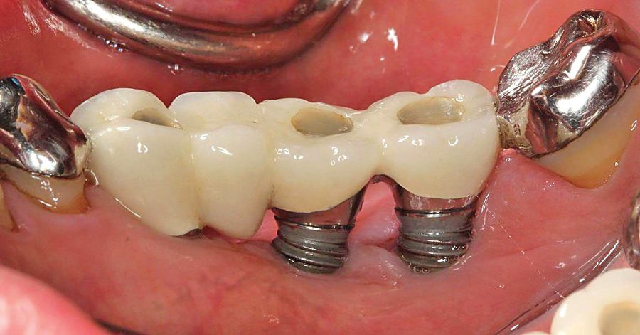 đào thải implant