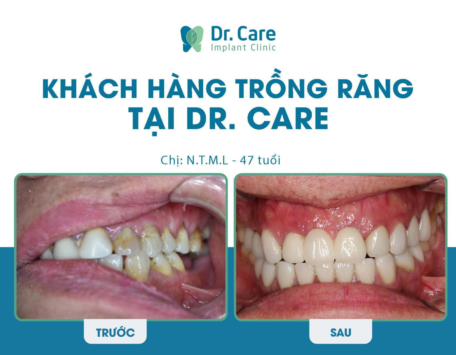 Khách hàng mất 1 răng trồng implant tại Dr. Care