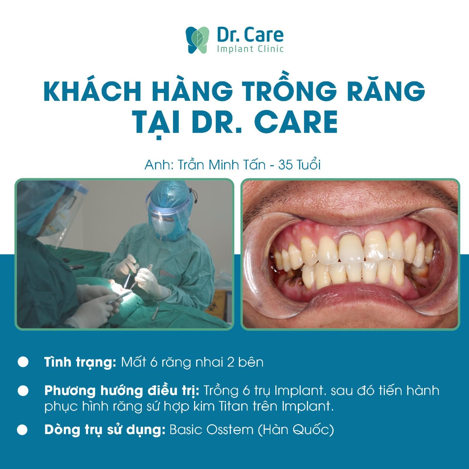 trụ implant hàn quốc