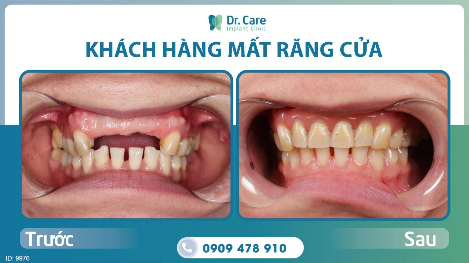 Trồng răng Implant vùng răng cửa khôi phục khả năng ăn nhai