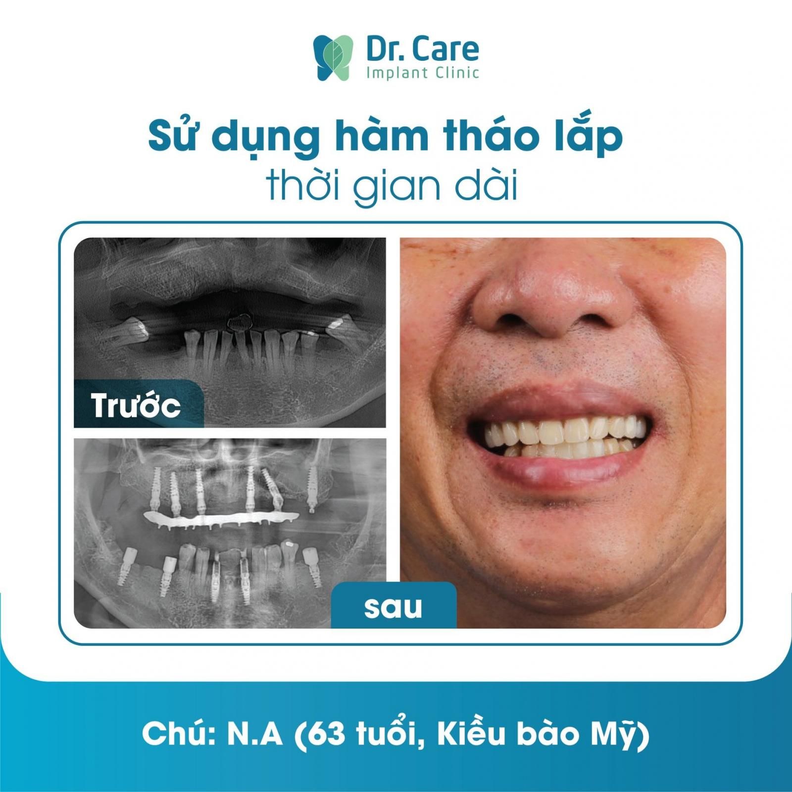 Mất răng lâu năm gây nhiều hậu quả cho sức khỏe