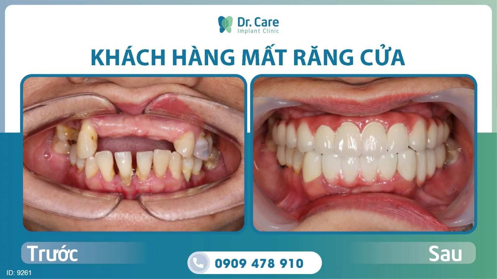 Implant răng cửa