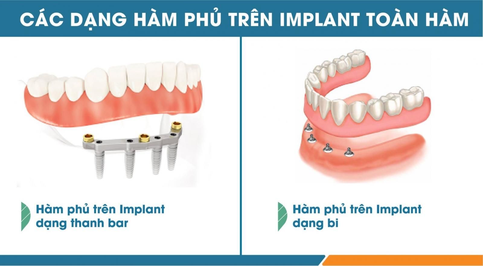 hàm tháo lắp trên implant