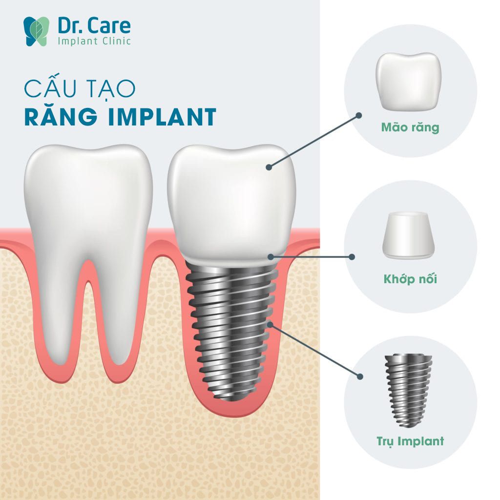 Trồng răng Implant là gì?