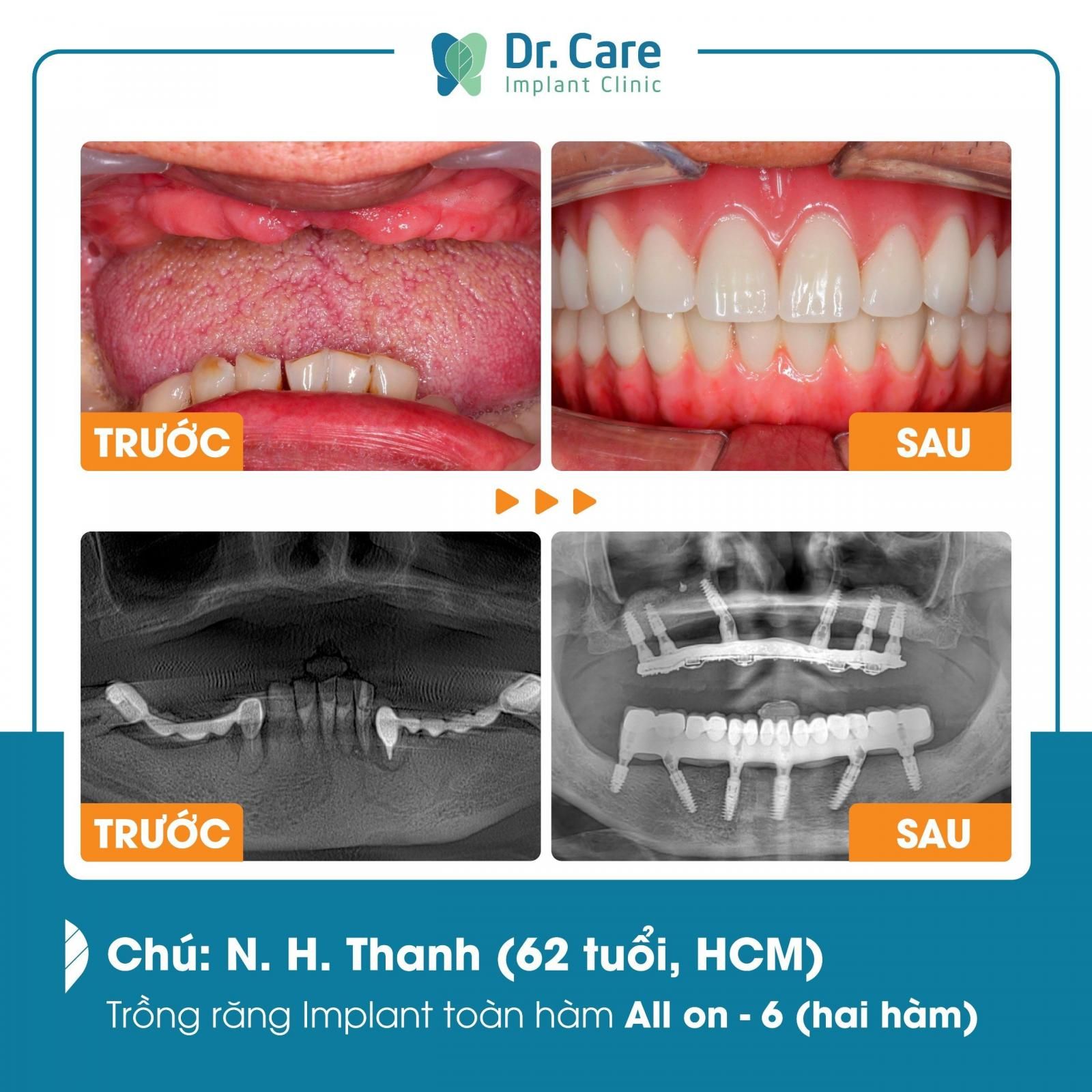 hàm tháo lắp trên implant