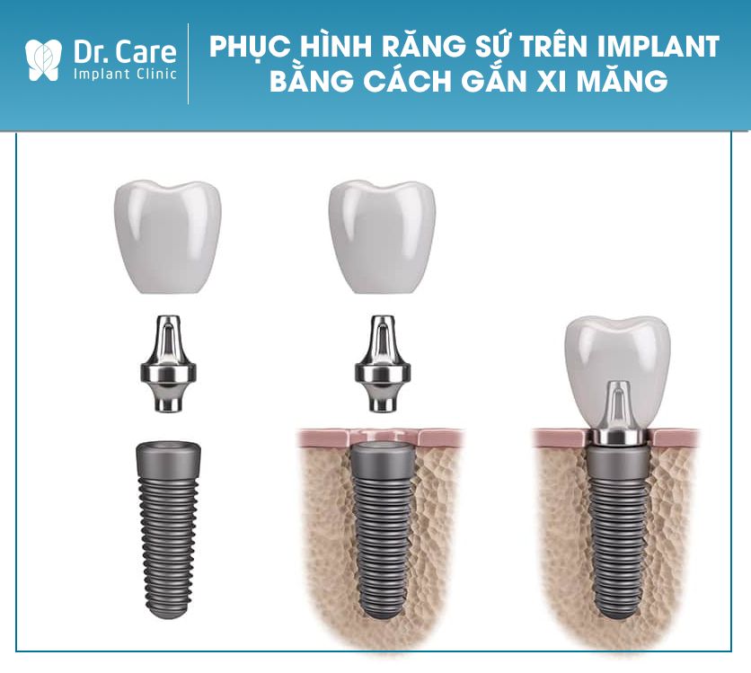 Phục hình răng sứ trên Implant bằng cách gắn xi măng