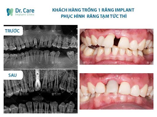 Các bước cắm implant