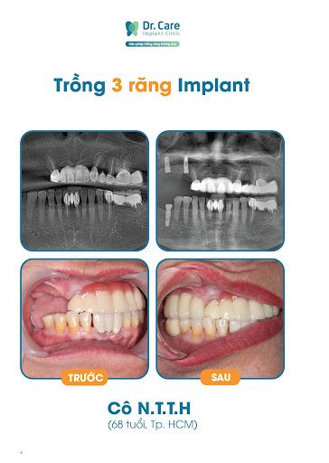 các bước cắm implant