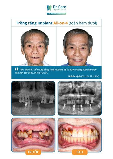 Trồng răng Implant