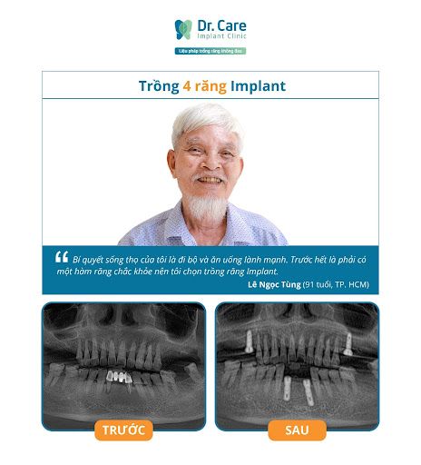 Trồng răng Implant là gì?