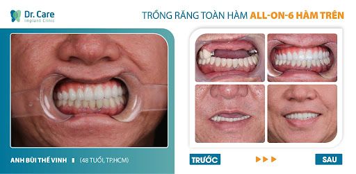 Chống chỉ định cấy implant