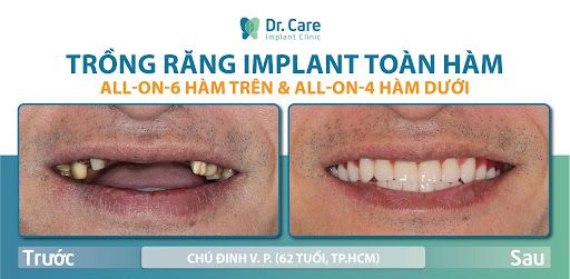 Chống chỉ định cấy implant