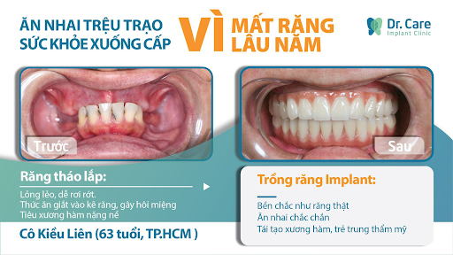 Chống chỉ định cấy implant