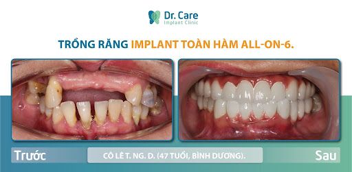 Chống chỉ định cấy implant