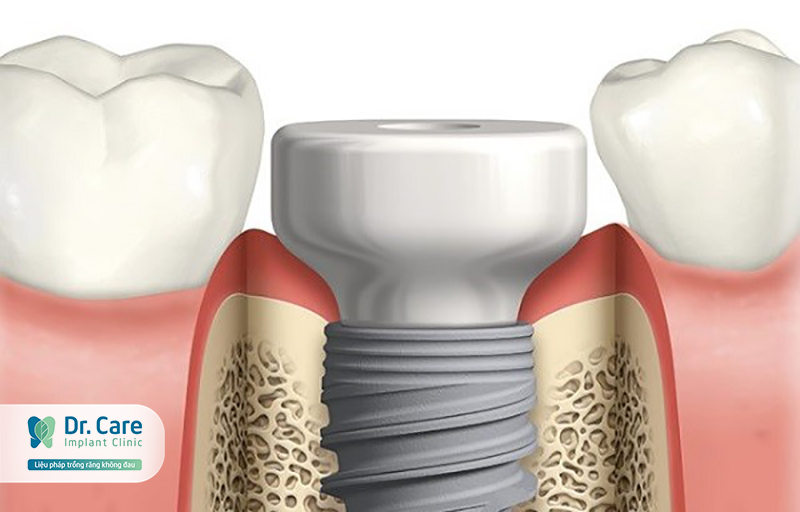 công dụng của trụ implant tekka