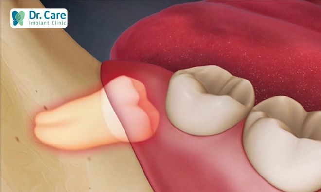 Mọc răng khôn phải làm thế nào để hạn chế đau là nỗi băn khoăn của nhiều người