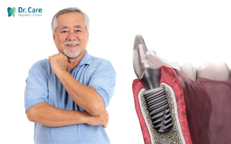 2 loại trụ Implant Pháp thông dụng tại Việt Nam