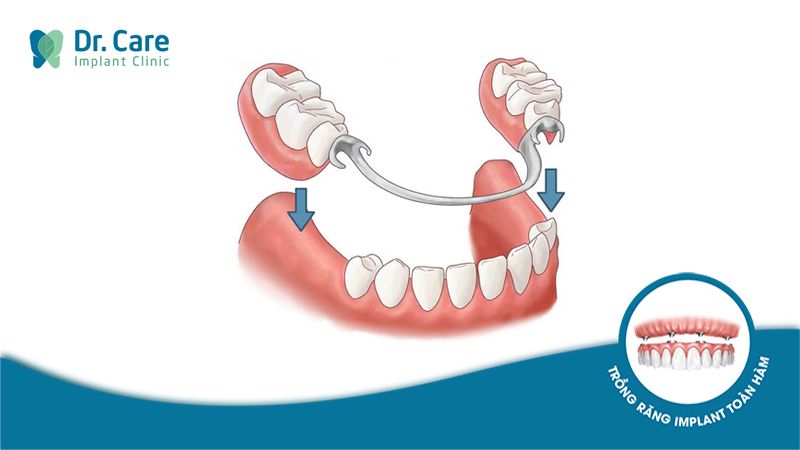 hàm khung tháo lắp kim loại là gì