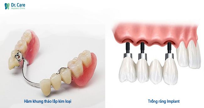 so sánh hàm khung tháo lắp kim loại và trồng răng Implant