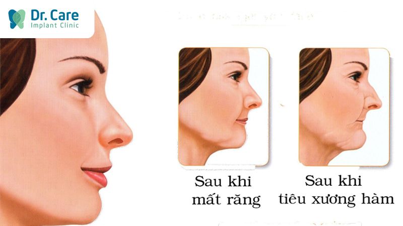 Những biến chứng nguy hiểm do mất răng hàm