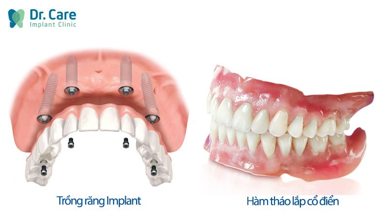 Mất răng toàn hàm trồng lại bằng phương pháp nào? 