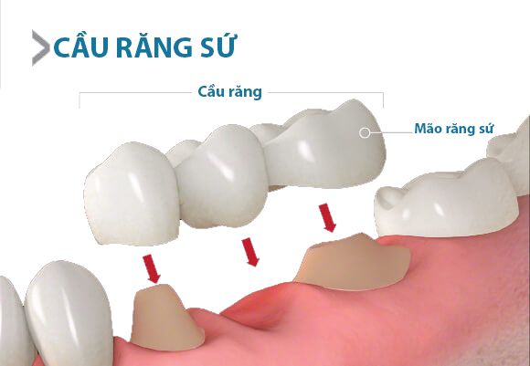 Cầu răng sứ