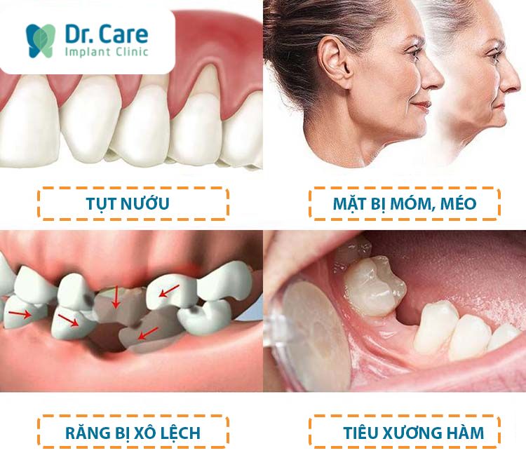 Mất răng không trồng lại có sao không?