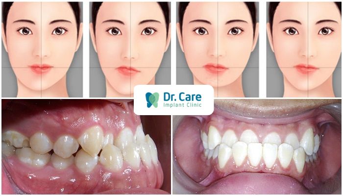 Mặt bị lệch là gì?