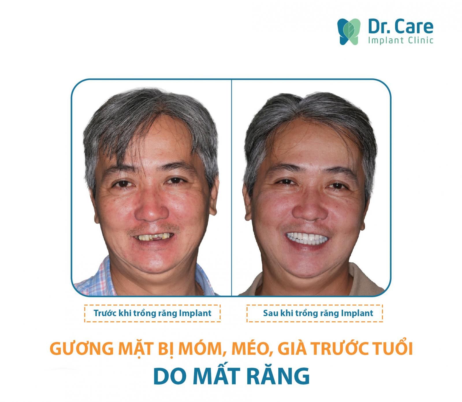 Tiêu xương răng, lão hóa sớm mất răng không trồng lại