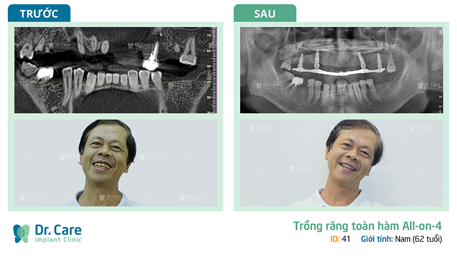 Trồng răng Implant khắc phục tình trạng mặt lệch do mất răng