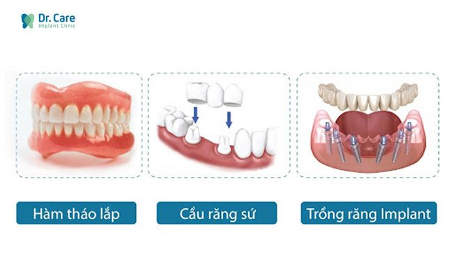 Mất răng trồng lại bằng phương pháp nào?