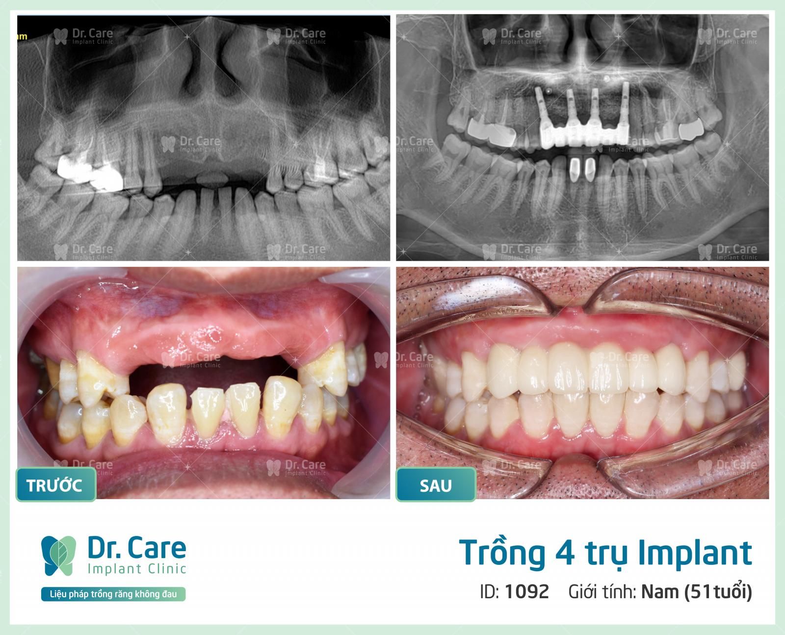 Mất 4 răng liên tiếp nhau thì trồng răng giả loại nào?