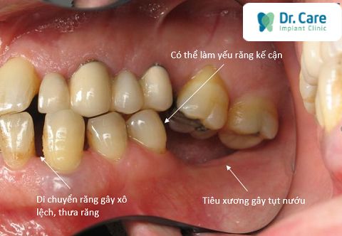 Mất răng cấm có sao không