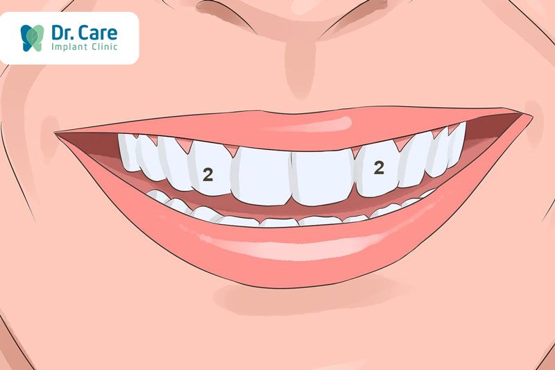 Chi phí trồng răng Implant phục hình mất răng số 2