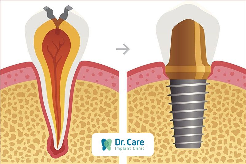 Mất răng số 2 khắc phục ra sao?