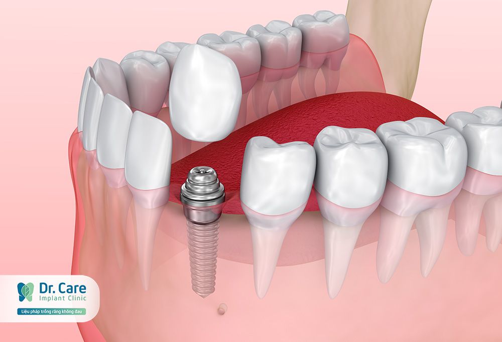 Phục hình mất răng số 3 bằng cách nào?