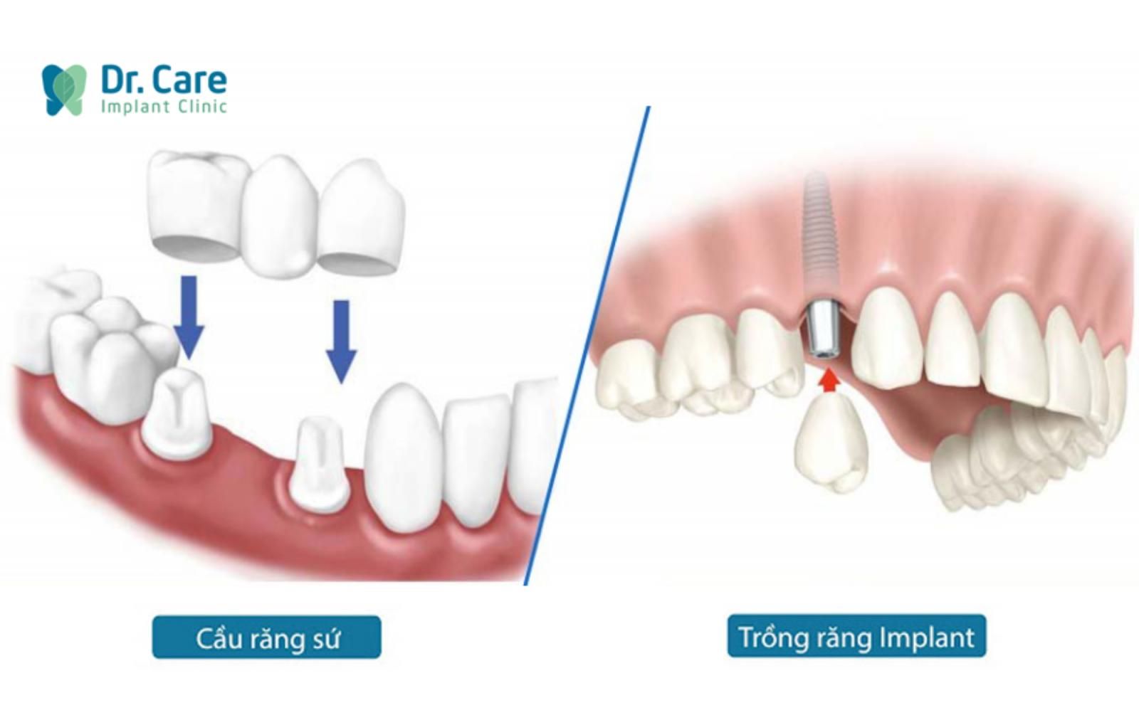 Phục hình mất răng hàm dưới bằng cách nào?