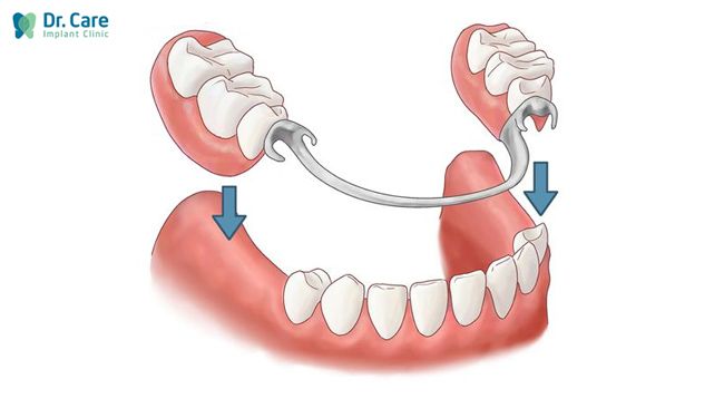 Chi phí phục hình tháo lắp bán phần