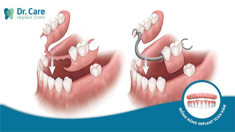 Hàm tháo lắp bán phần là gì?