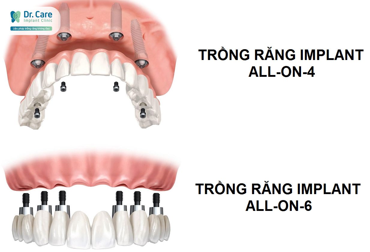 Trồng răng Implant khắc phục nhược điểm hàm tháo lắp bán phần