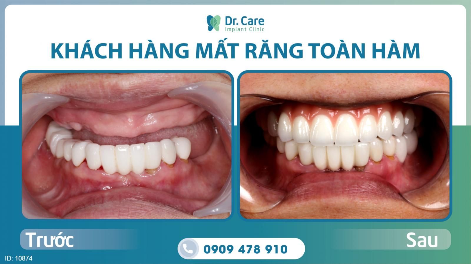 Chi phí trồng răng Implant toàn hàm tại Dr. Care