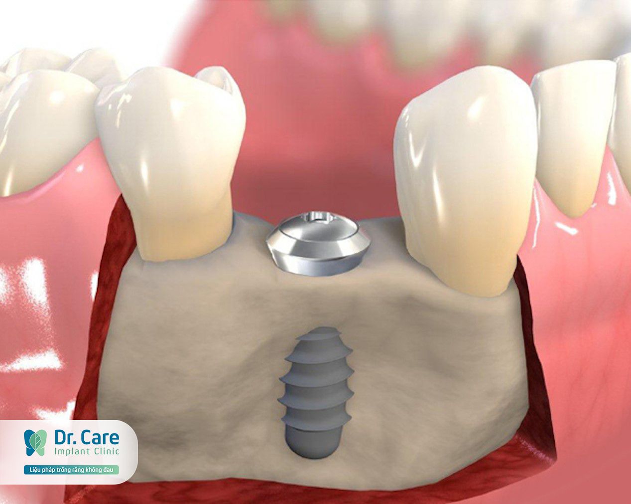 Trụ MIS C1 có thiết kế đặc biệt ngăn ngừa tiêu xương hàm hiệu quả