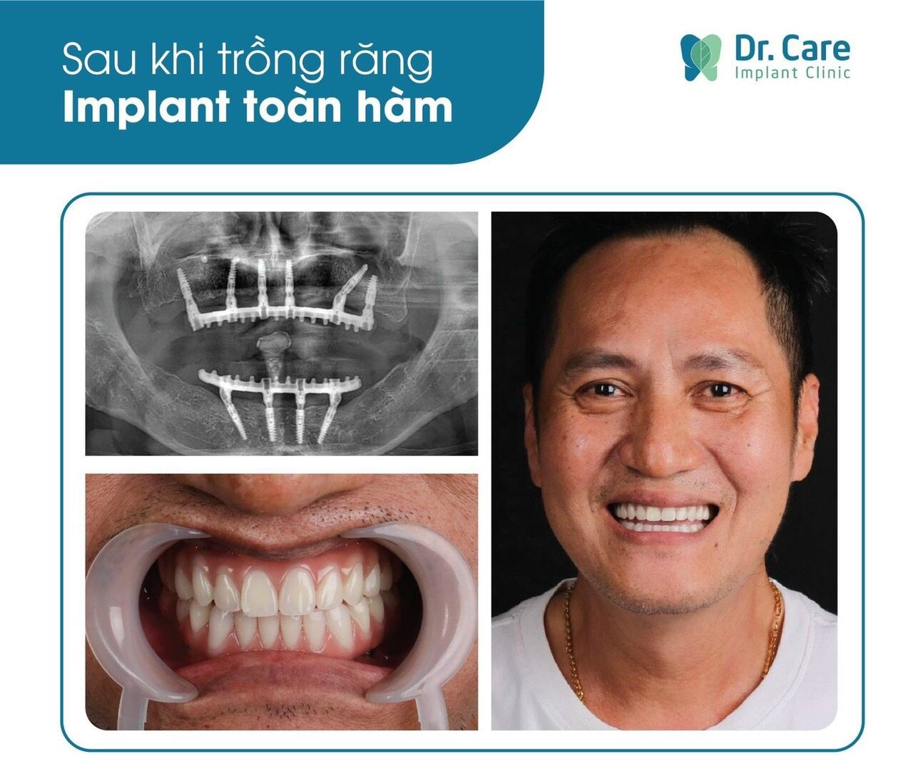 Nhật ký trồng răng Implant